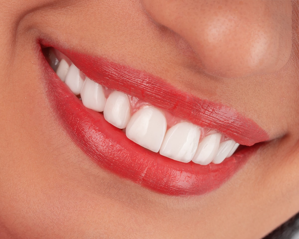 Sorriso após tratamento estético, dentes claros e alinhados